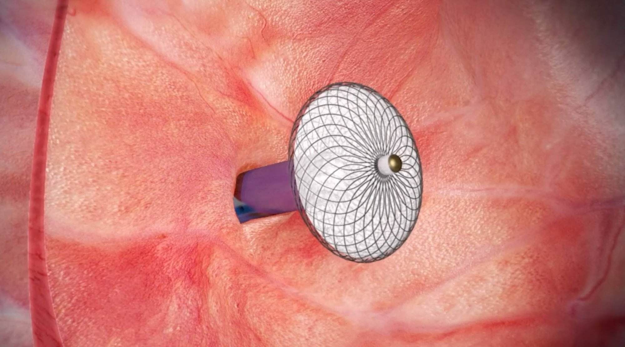 PFO kapatma, şemsiye ile ameliyatsız yöntem