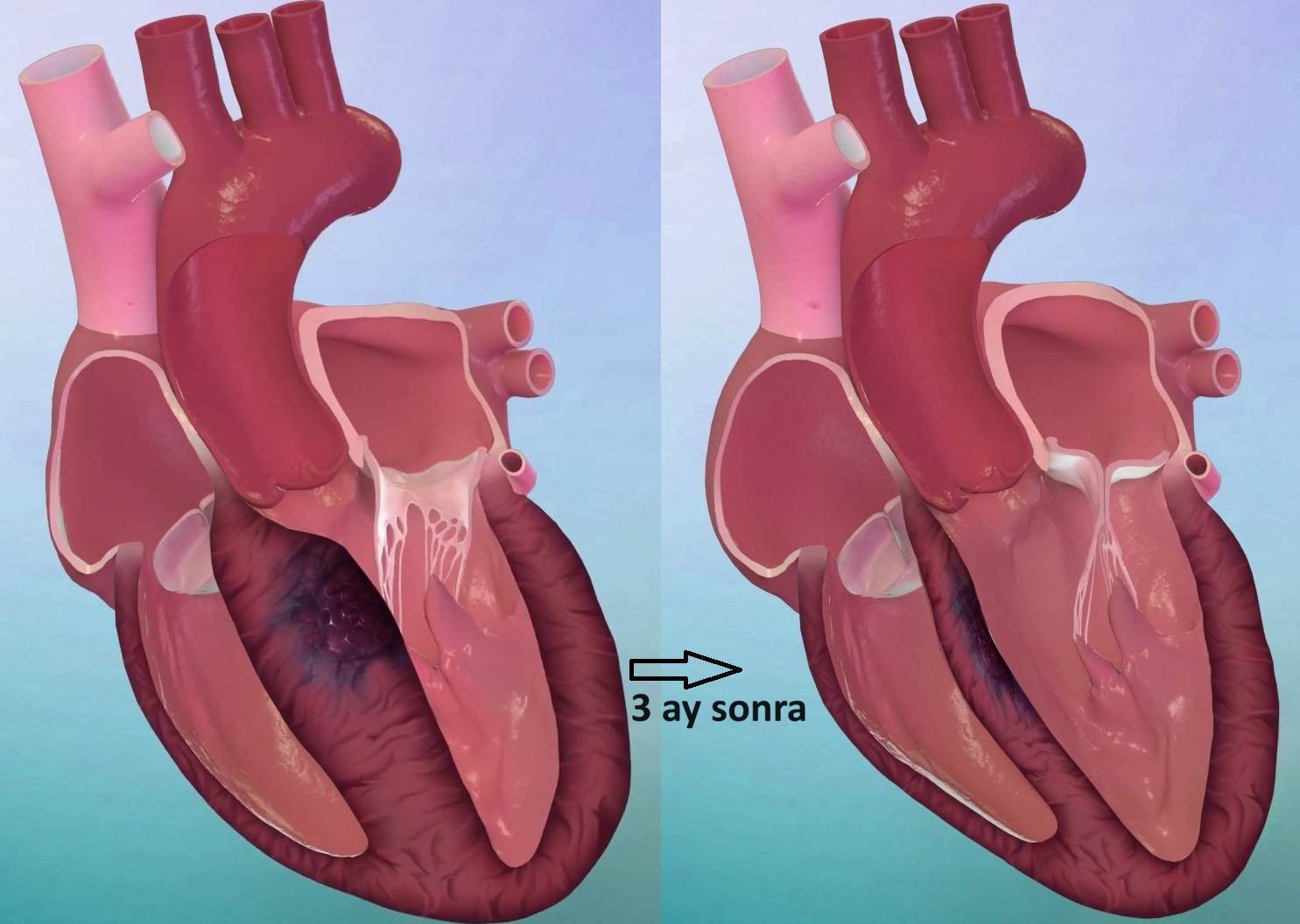 Alkol septal ablasyon