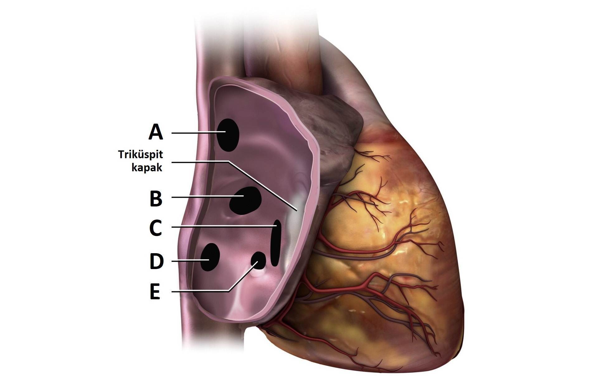 atrial septal defekt