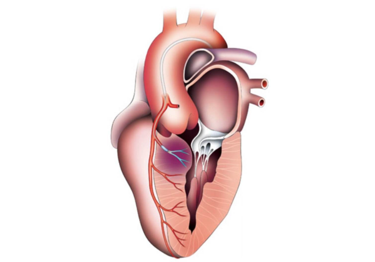 Alkol septal ablasyon Obstrüktif hipertrofik kardiyomiyopati