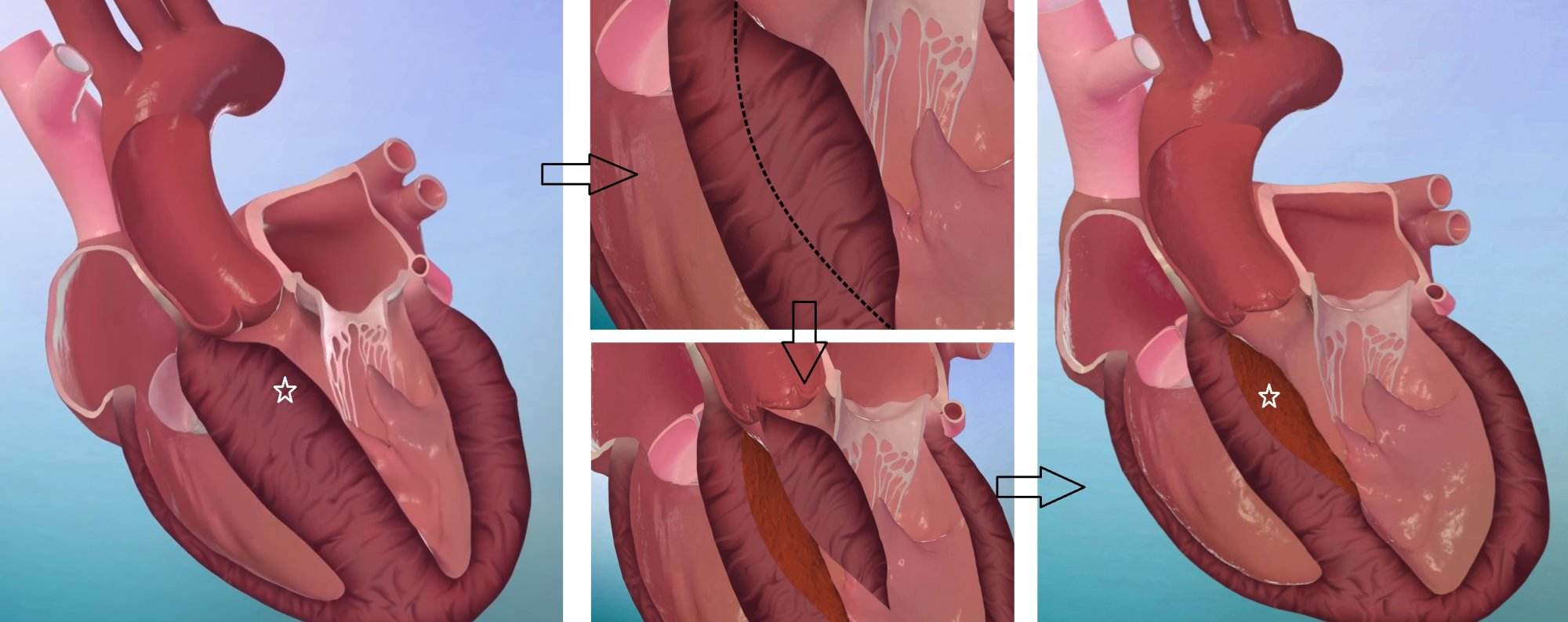 Septal miyektomi ameliyatı