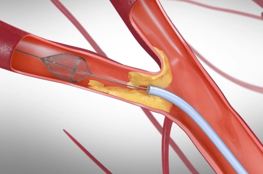 Carotid stenting