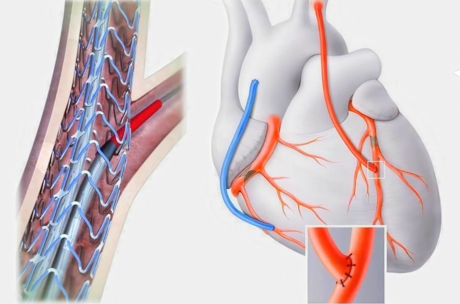 Bypass mı, stent mi?