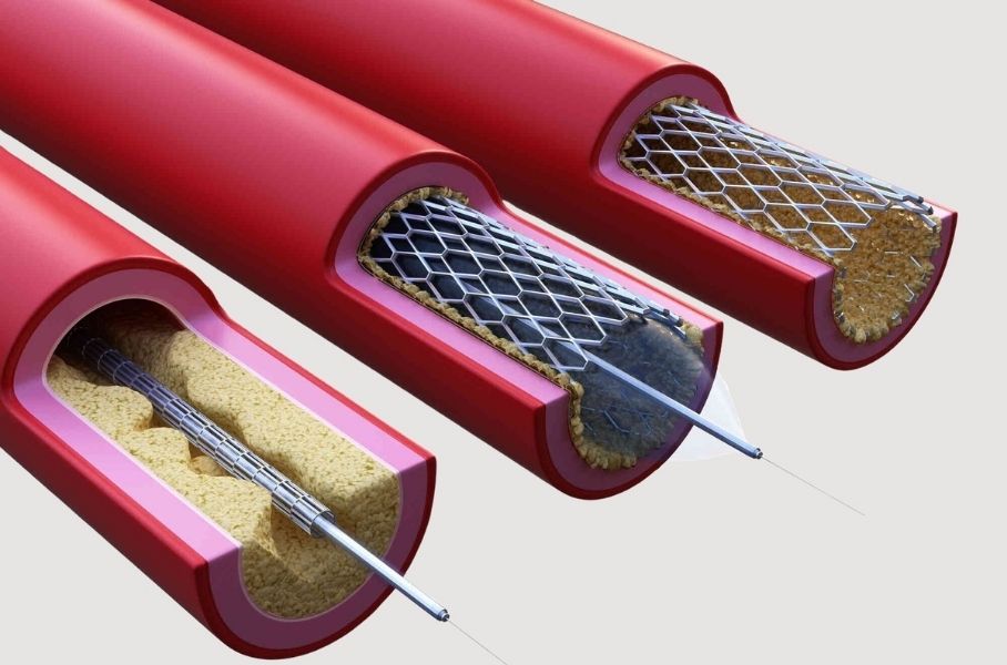 Stent nasıl takılır