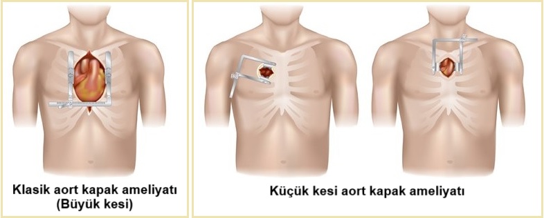 Kalp Ameliyatı