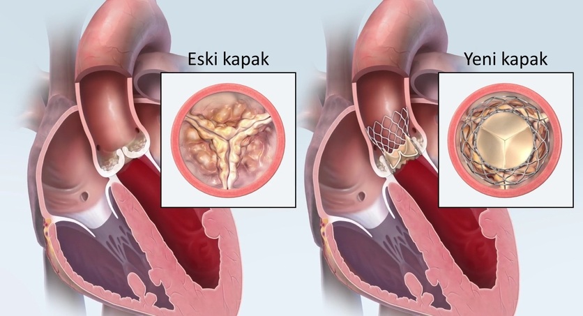 transcatheter aortic valve implantation