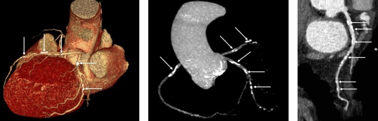 Koroner kalsifikasyon BT vaka