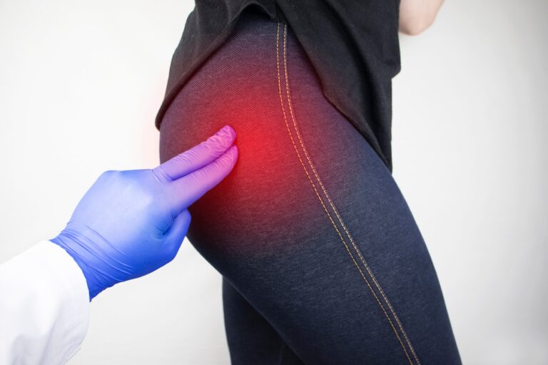 Falsa fuerza en cuádriceps y glúteos: el error común en la condromalacia rotuliana