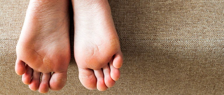 ¿Tienes fascitis plantar? Estas son las claves para curarla desde casa