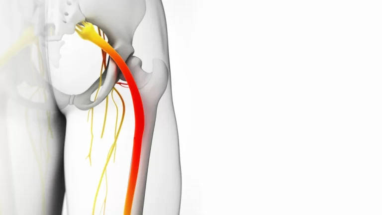 ¿Cuál es la causa real del síndrome piramidal cuando no hay una lesión física?