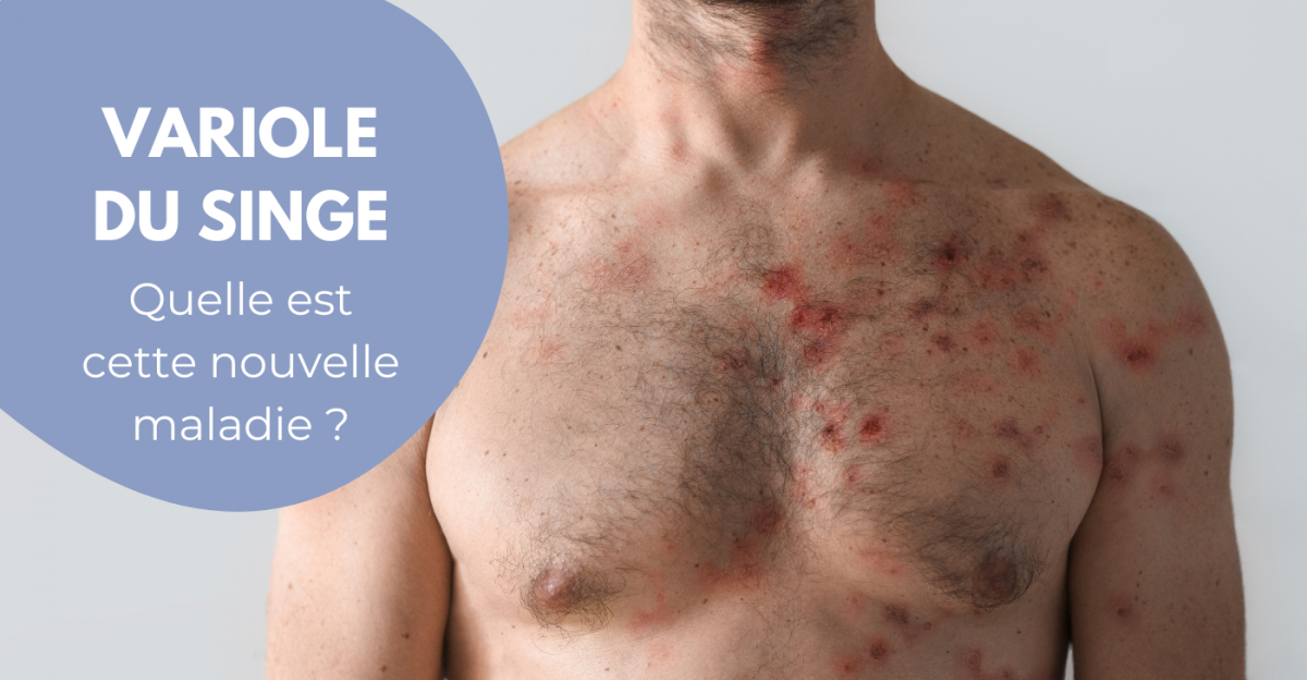 Qu’est-ce que la variole du singe ?