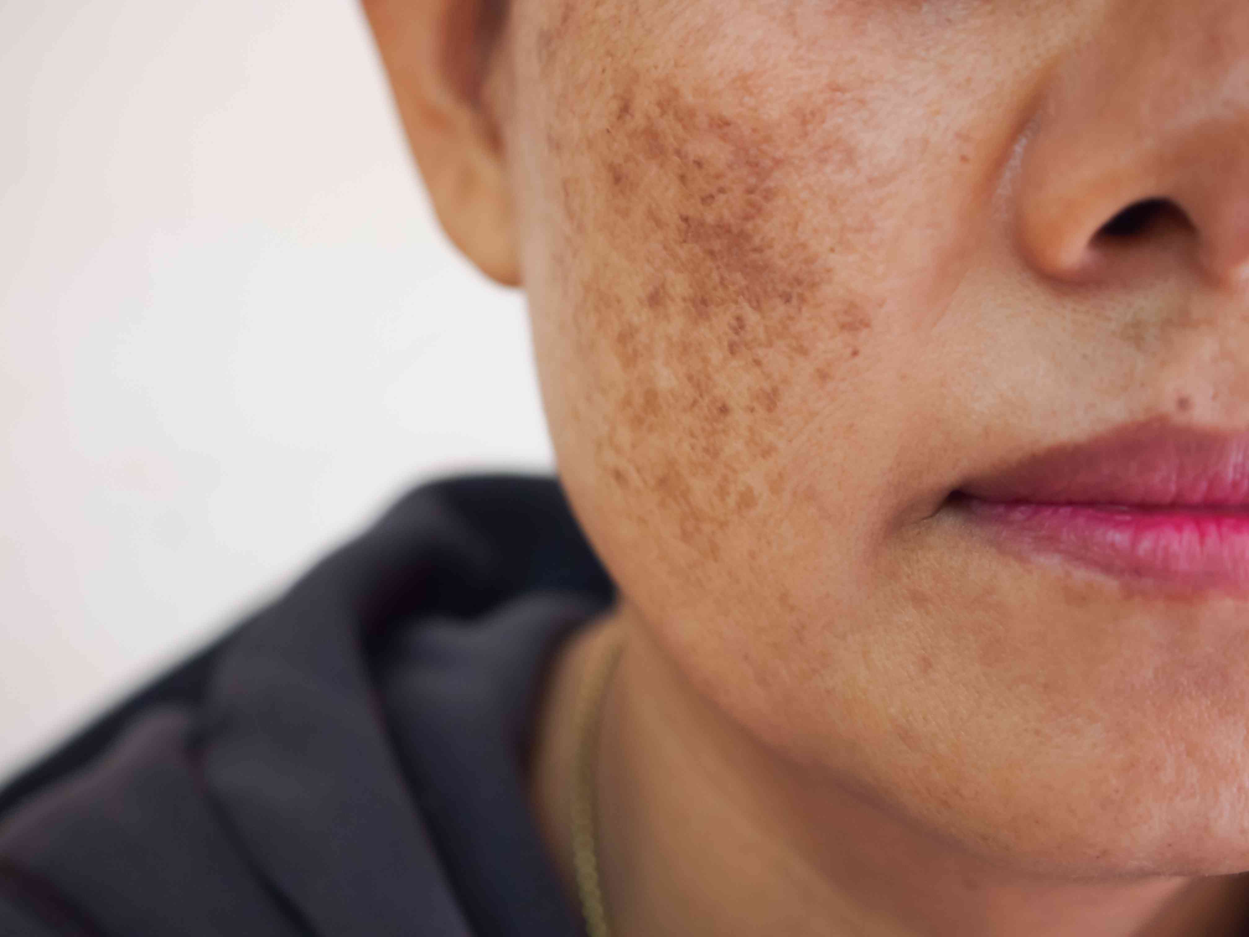 30_Pigmentation2.jpg