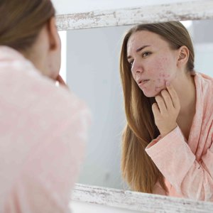 Acne.original.jpg