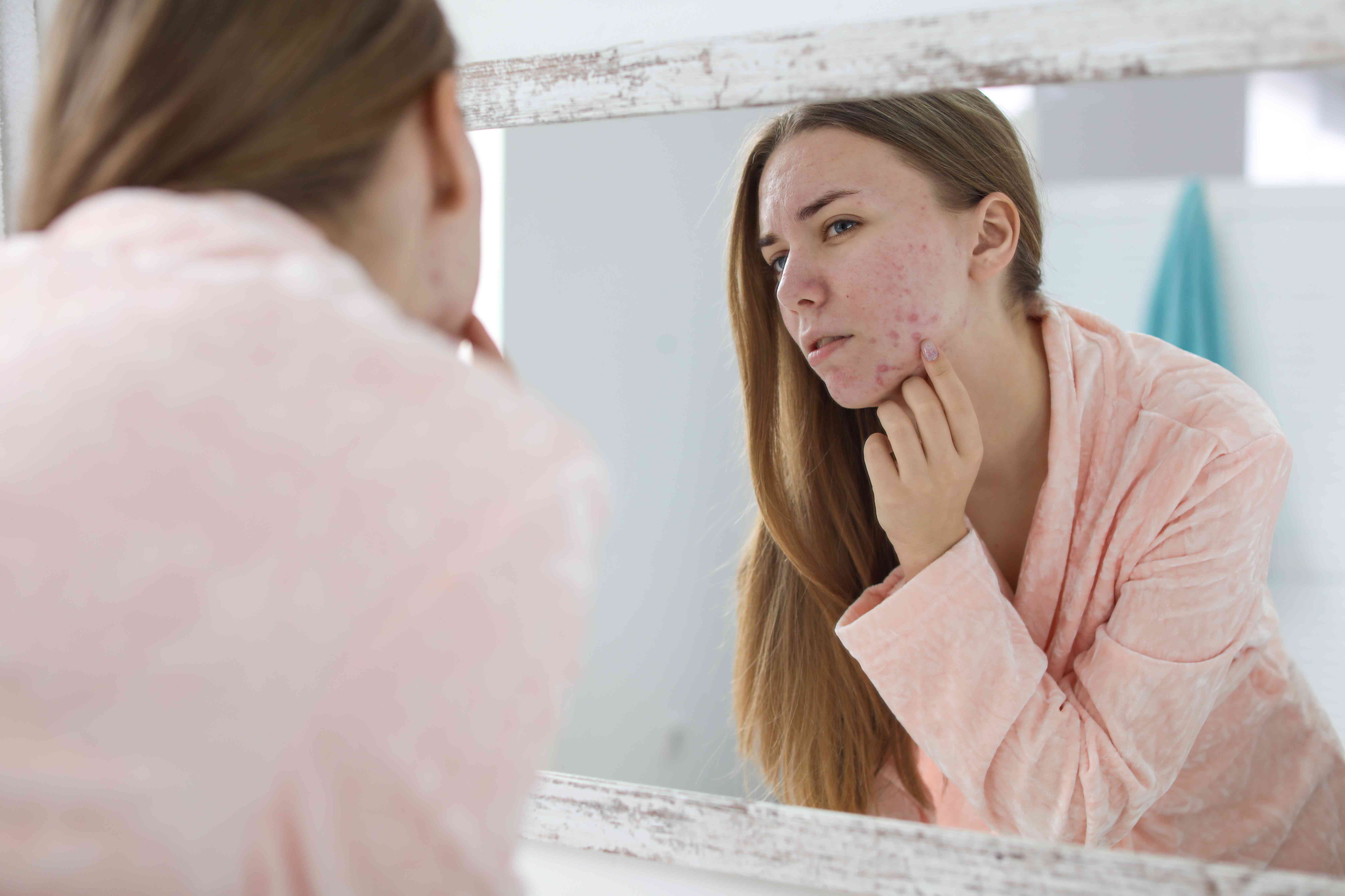 Acne.original.jpg
