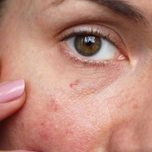 FacialThreadVeins.jpg