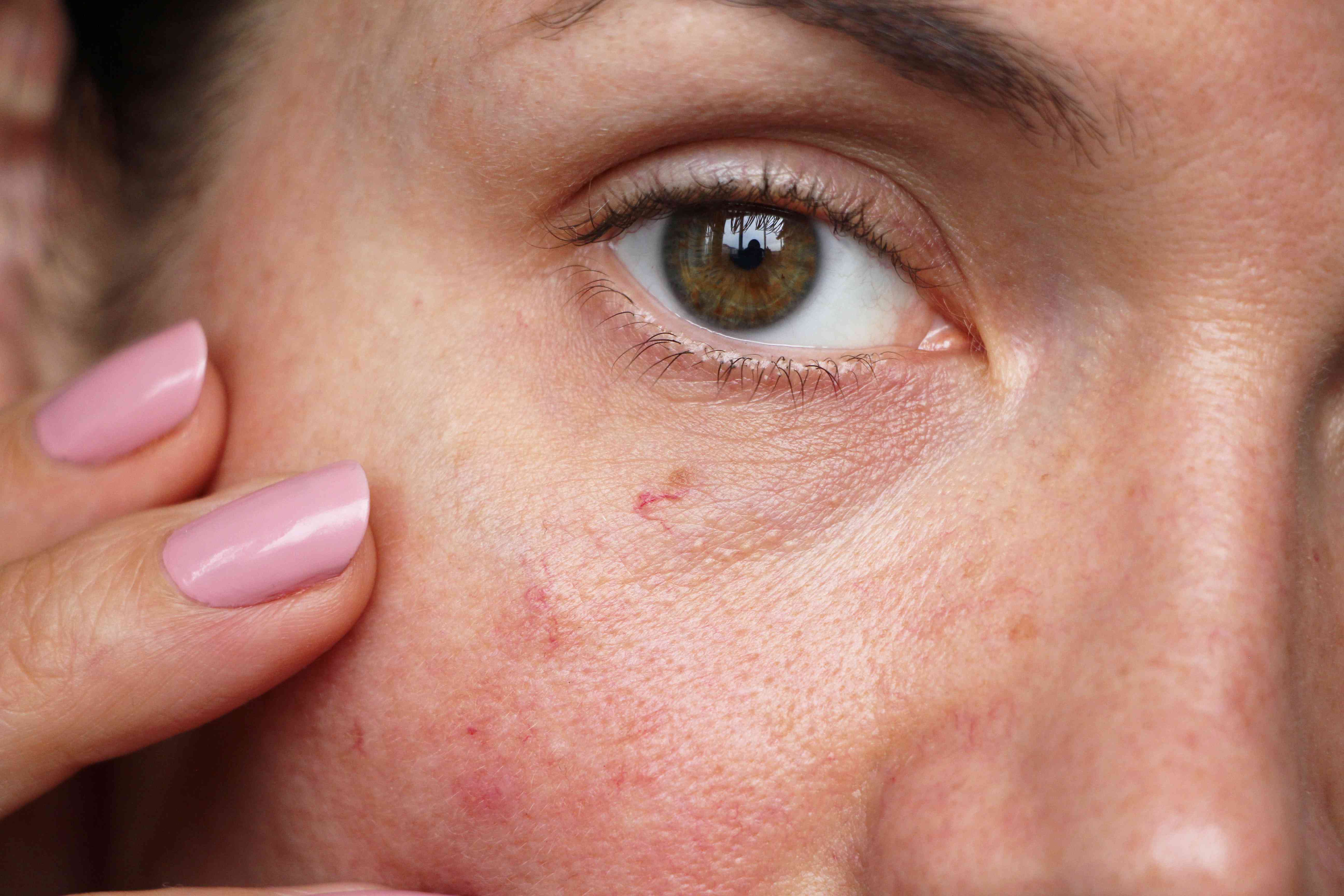 FacialThreadVeins.jpg