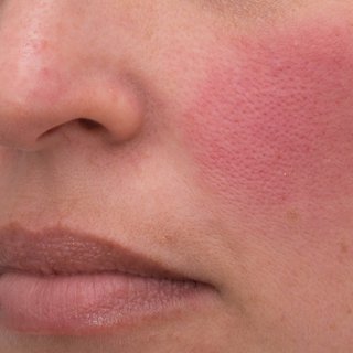 Rosacea flare up