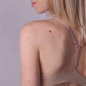 SkinTag.jpg