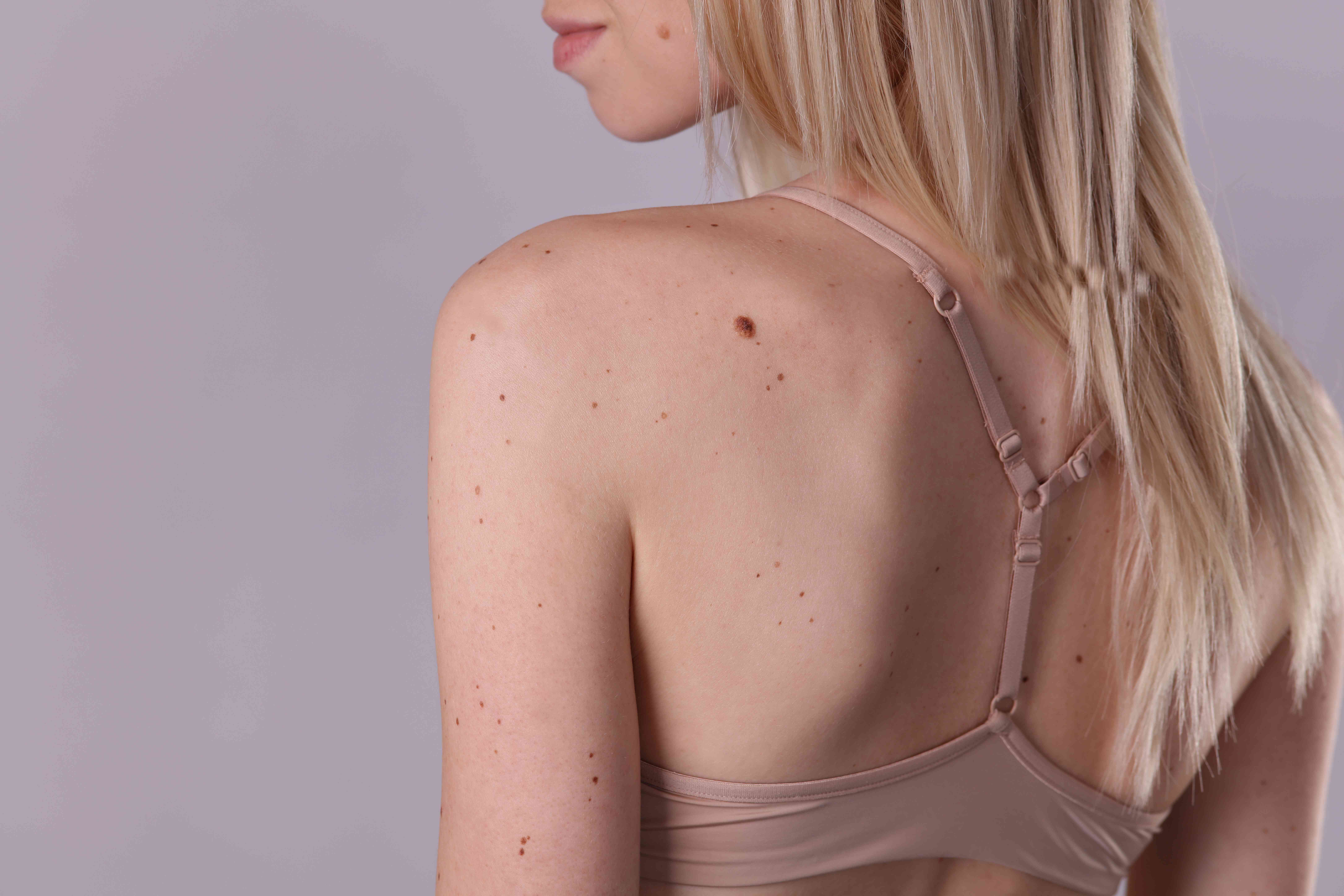SkinTag.jpg