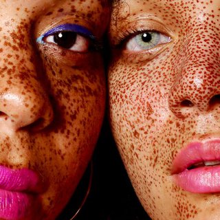 hyper-pigmentation