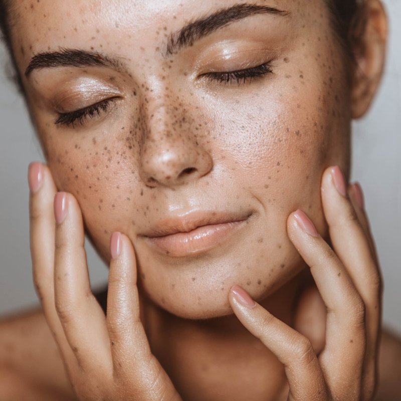 freckles