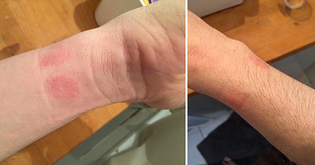 Owners of Apple Watch began to complain of skin irritation