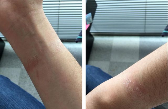 Owners of Apple Watch began to complain of skin irritation